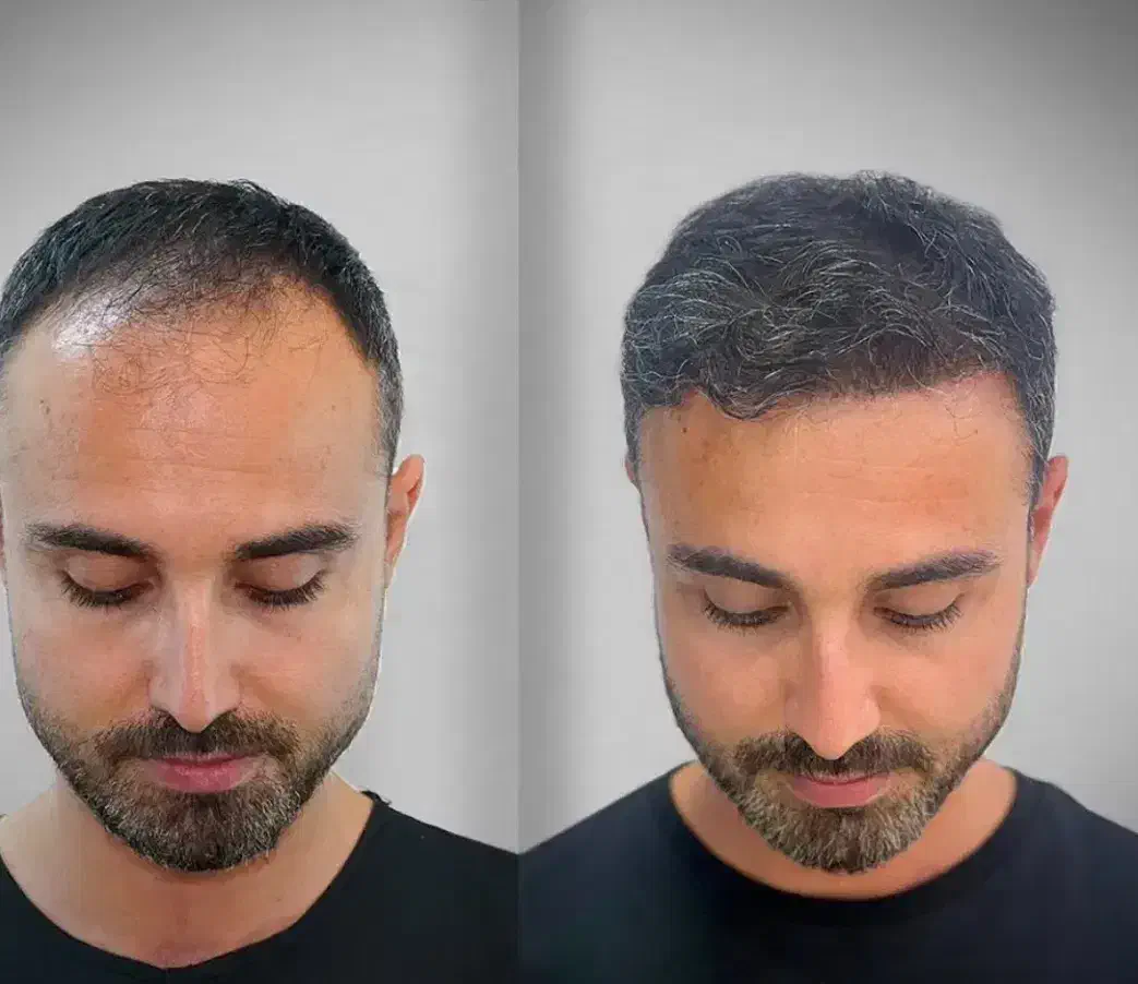 فیلر سی سی۳۳۰ بلفاروپلاستی ۶/۹۰۰ بوتاکس ۲۵۰|خدمات آرایشگری و زیبایی|تهران, صادقیه|دیوار