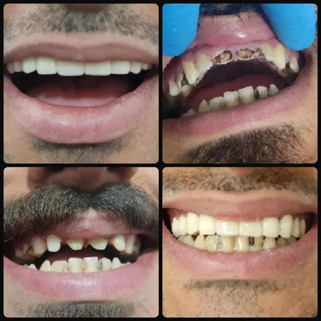 قسطی ایمپلنت و تمام خدمات دندانپزشکی بدون پیش|خدمات آرایشگری و زیبایی|اصفهان, دشتستان|دیوار