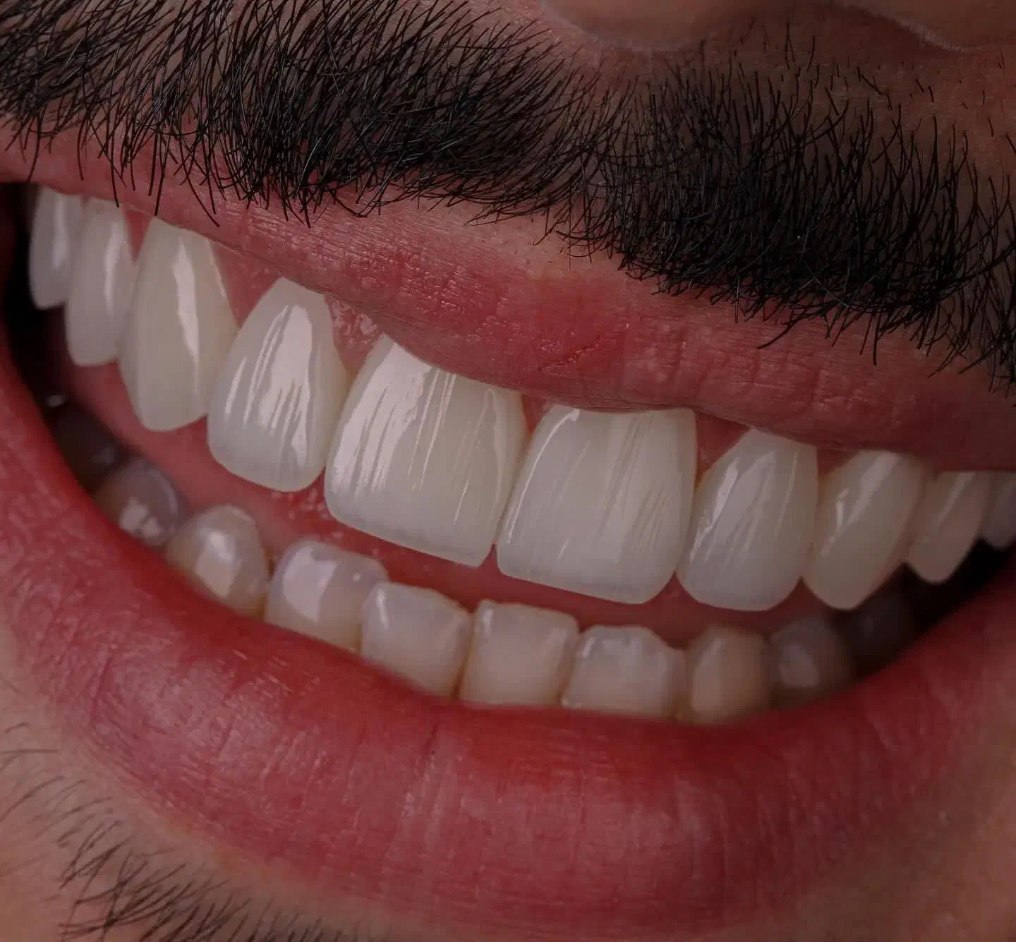 دندانپزشکی ایمپلنت دیجیتال ارتودنسی کامپوزیت لمینت|خدمات آرایشگری و زیبایی|شبستر, |دیوار