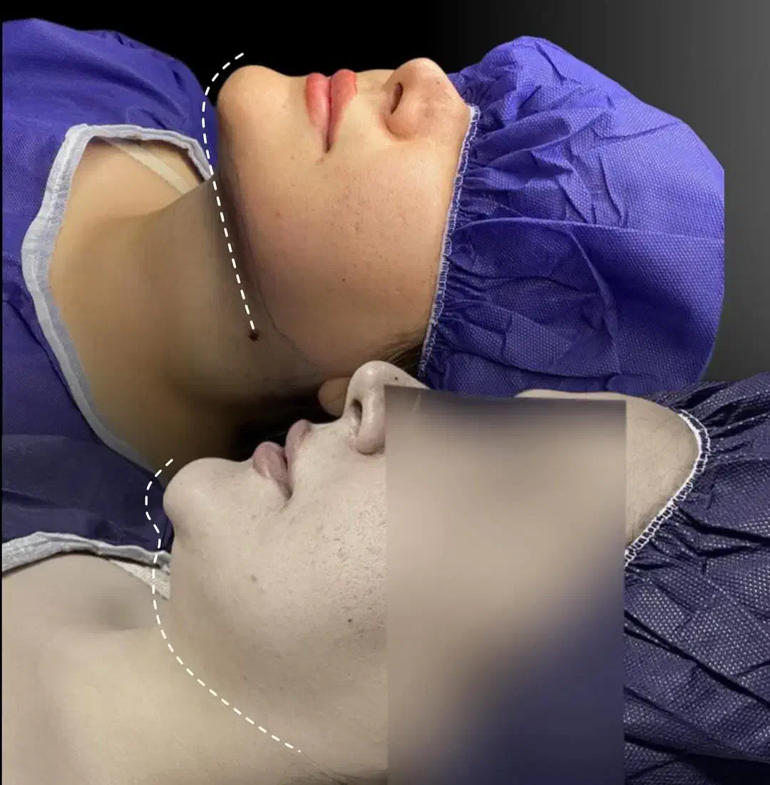 ساکشن غبغب|خدمات آرایشگری و زیبایی|یاسوج, |دیوار