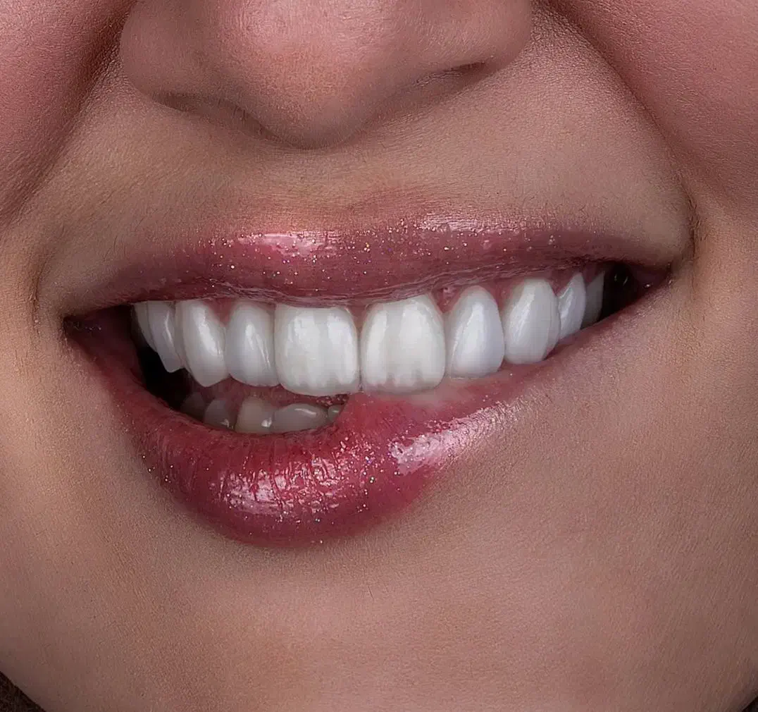 ایمپلنت8 تومن/کامپوزیت2تومن/عصب کشی/لمینت|خدمات آرایشگری و زیبایی|مشهد, سجاد شهر|دیوار