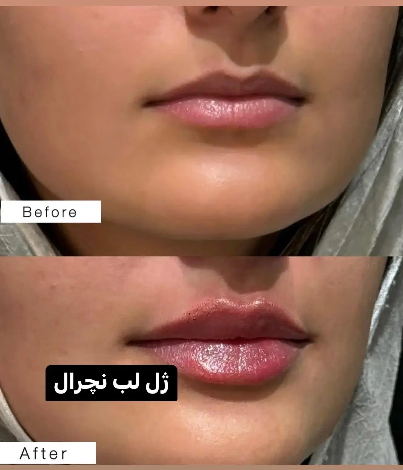 آف تزریق ژل وبوتاکس ومزوژل جوانساز|خدمات آرایشگری و زیبایی|آمل, |دیوار