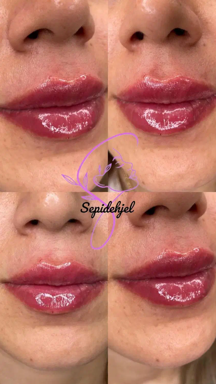 ژل و بوتاکس مزو و انزیم، سیار هستم...|خدمات آرایشگری و زیبایی|قرچک, شهرک طلائیه|دیوار