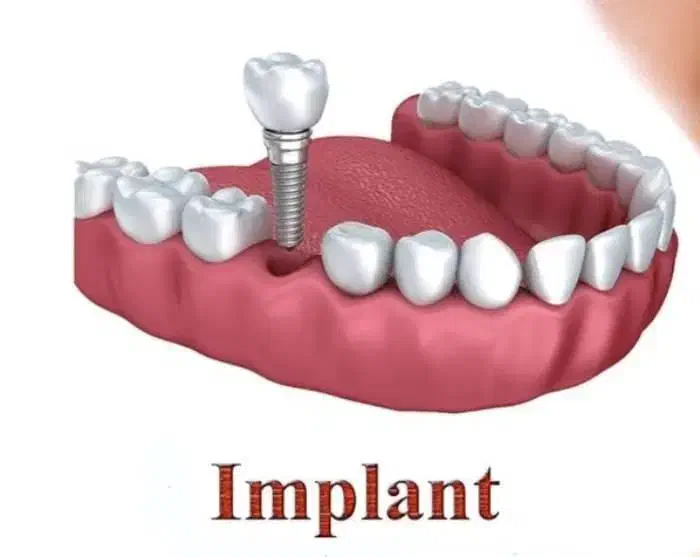 ایمپلنت دندان ۷۹۰۰ با ضمانت ۲۰ ساله|خدمات آرایشگری و زیبایی|کرج, عظیمیه|دیوار
