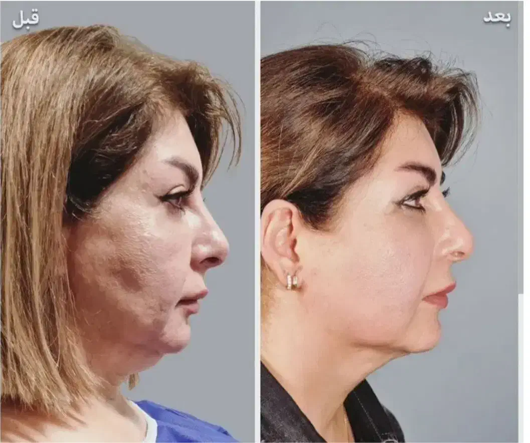 جراحی بلفاروپلاستی وجراحی های زیبایی و تزریقات|خدمات آرایشگری و زیبایی|قائمشهر, |دیوار