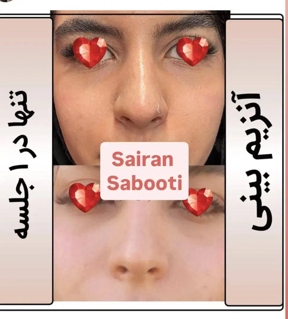 آنزیم بینی گوشتی غبغب پلاسما تراپی|خدمات آرایشگری و زیبایی|شیراز, محراب|دیوار