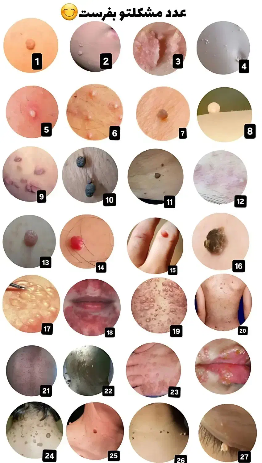 تبخال و زگیل تناسلی|آرایشی، بهداشتی، درمانی|اهرم, |دیوار