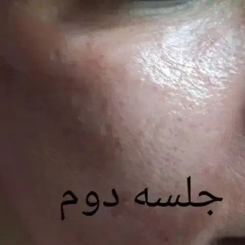 مزو تراپی|خدمات آرایشگری و زیبایی|مشهد, کارگران|دیوار