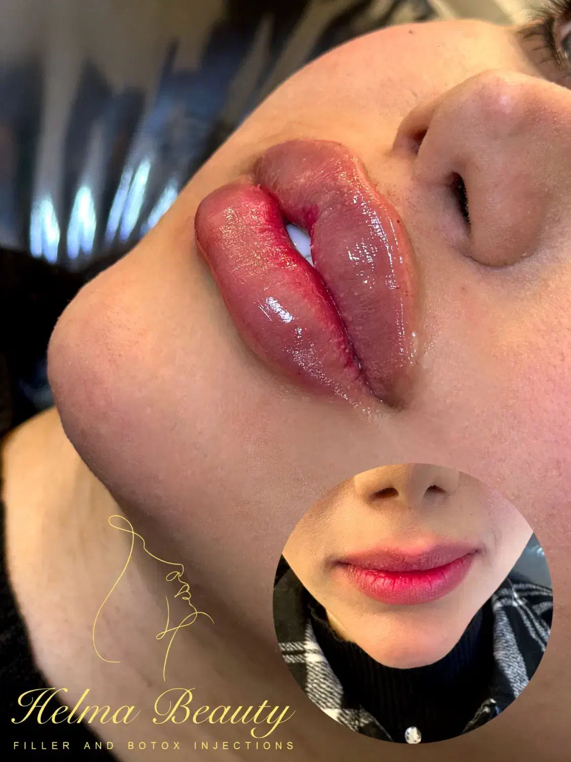 تزریق ژل و بوتاکس و انزیم و مزوجوانساز.|خدمات آرایشگری و زیبایی|پاکدشت, شهرک امام رضا|دیوار