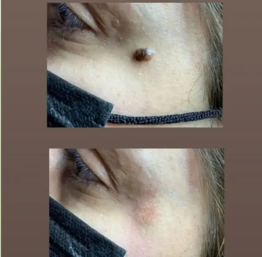 برداشت خال با خلال دندان|آرایشی، بهداشتی، درمانی|تربتحیدریه, پارک پرستار|دیوار