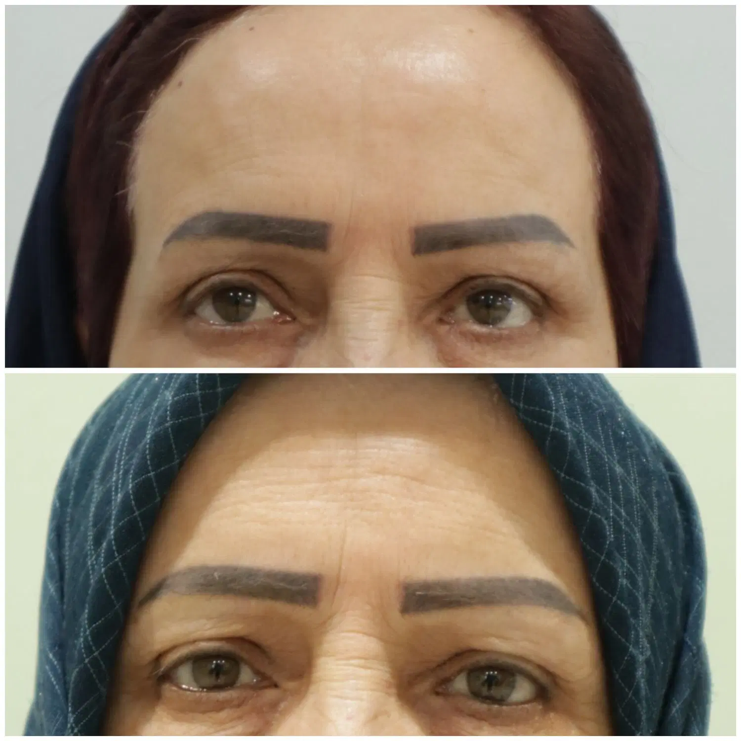 بوتاکس|خدمات آرایشگری و زیبایی|سنقر, |دیوار