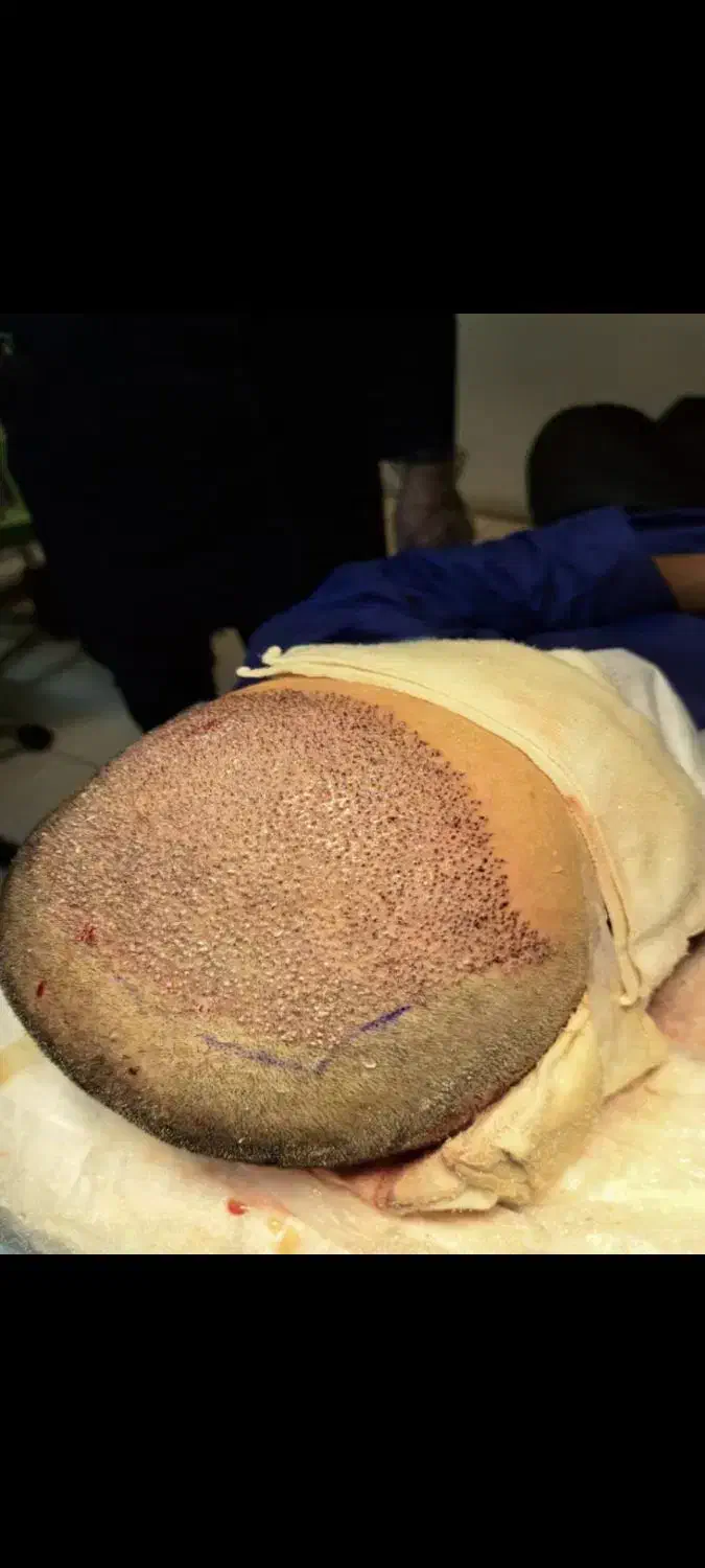 کاشت مو|خدمات آرایشگری و زیبایی|ایلام, |دیوار