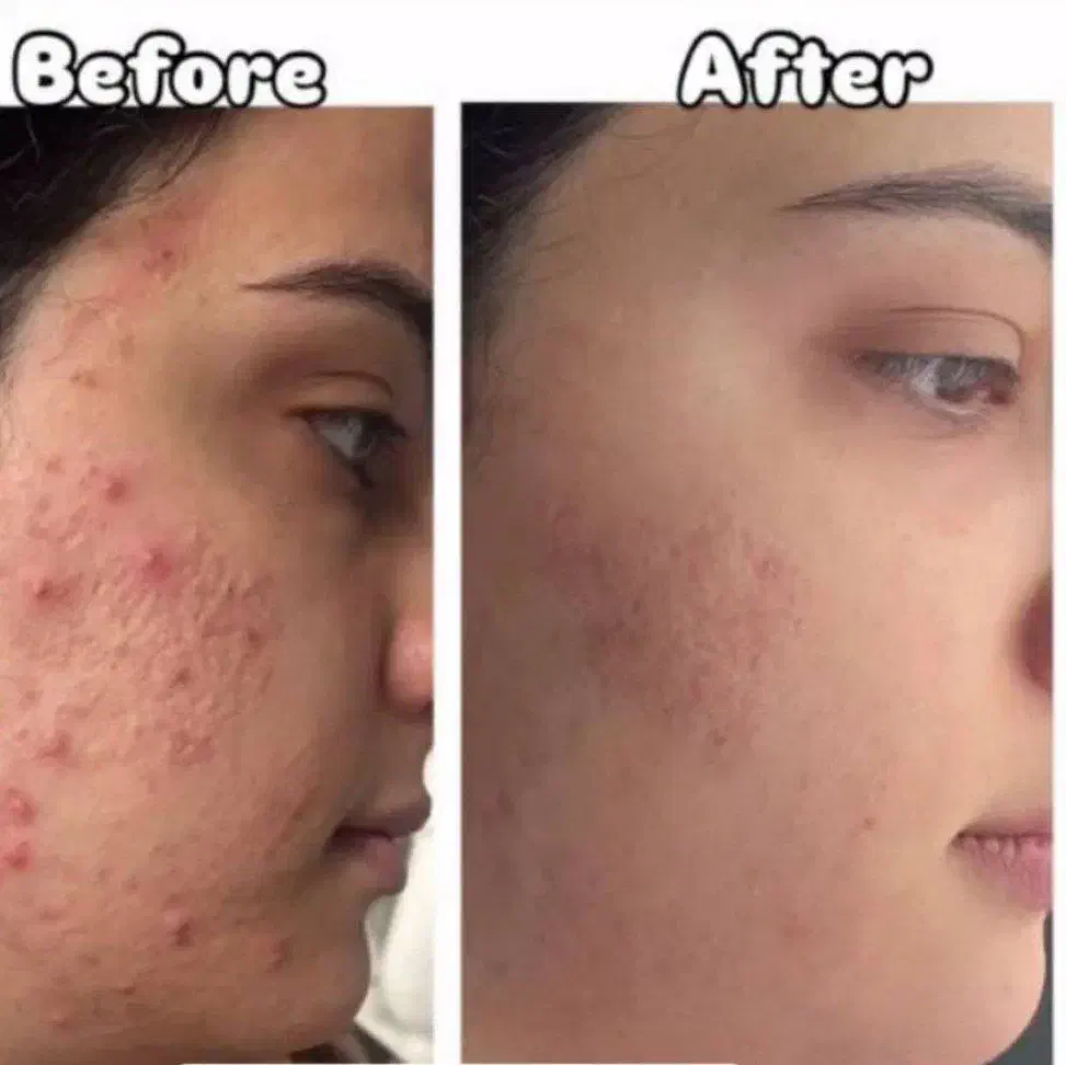 پک پوستی ضد جوش|آرایشی، بهداشتی، درمانی|خوی, |دیوار