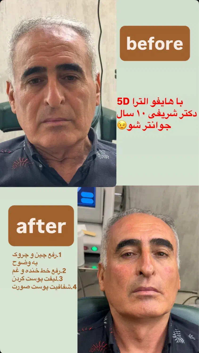 تخفیف لیزر فول بادی۵۱۹،بیشترین جوابدهی|خدمات آرایشگری و زیبایی|سقز, |دیوار