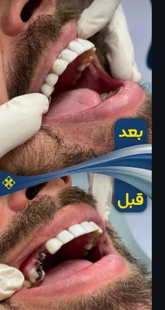 خدمات تخصصی ایمپلنت و اوردنچر دیجیتال|خدمات آرایشگری و زیبایی|کرج, جهان‌شهر|دیوار