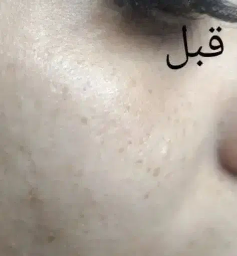 مزو تراپی|خدمات آرایشگری و زیبایی|مشهد, کارگران|دیوار