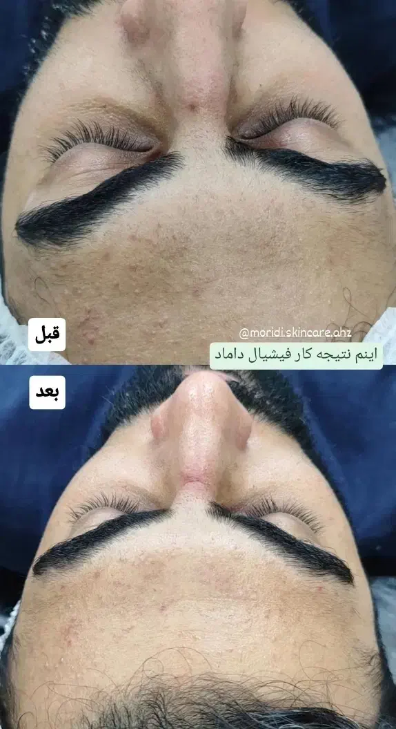 پاکسازی و فیشیال تخصصی در اهواز|خدمات آرایشگری و زیبایی|اهواز, بهارستان|دیوار