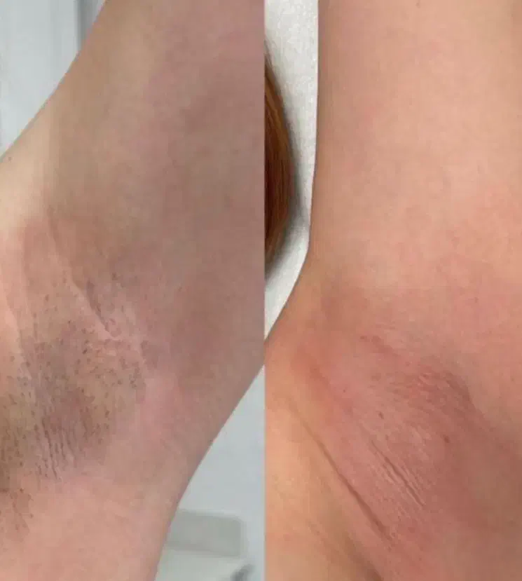 لیزر الکساندرایت. رفع تیرگی بدن. حذف تاتو|خدمات آرایشگری و زیبایی|تربت‌حیدریه, فرمانداری|دیوار