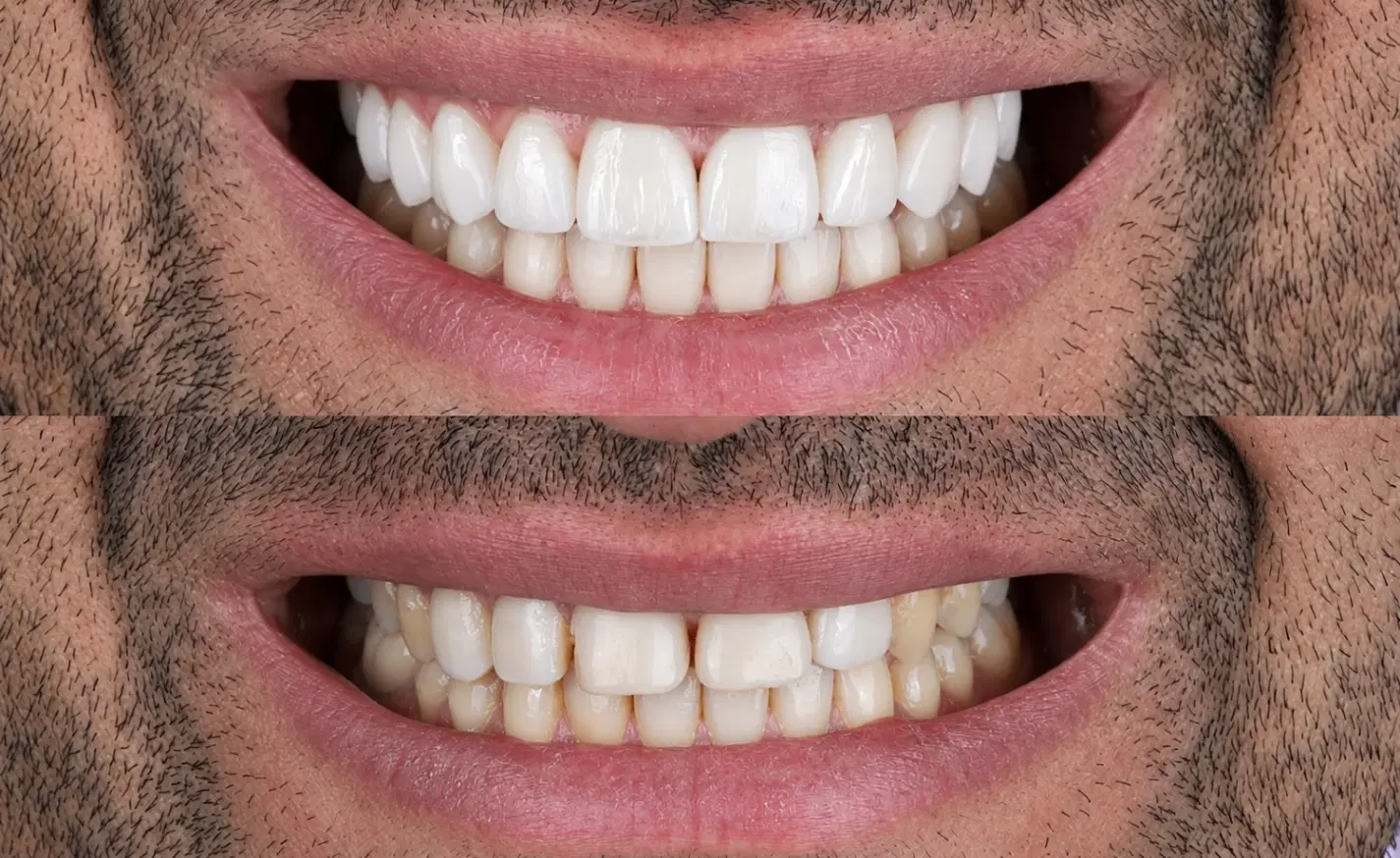 بیمار زیبایی لمینیت برای دوره دندانپزشکی|خدمات زیبایی و سلامت|تهران, امانیه|دیوار