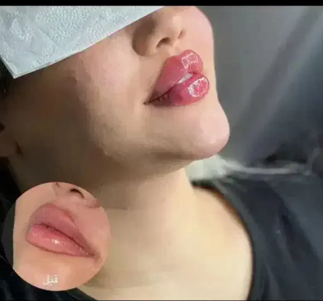 ژل ،فیلر و بوتاکس|خدمات آرایشگری و زیبایی|صفادشت, |دیوار