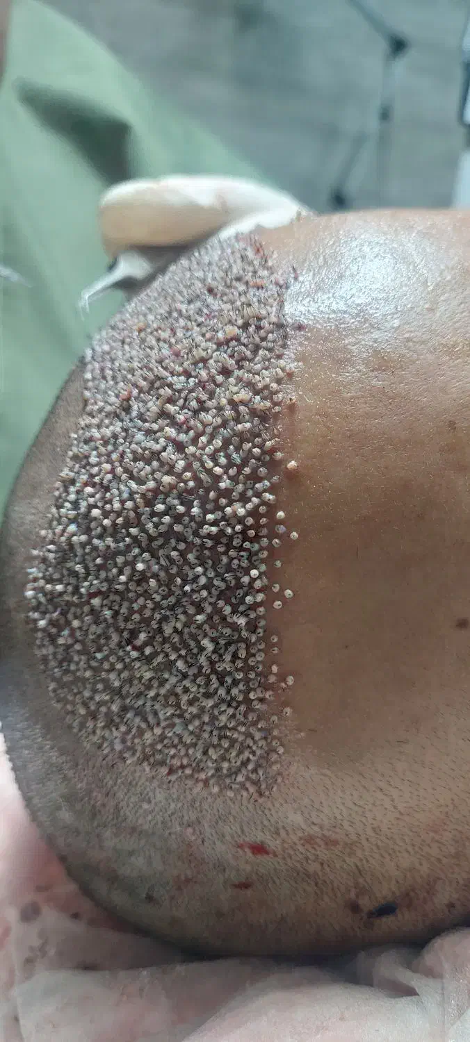 تخفیف ویژه کاشت مو و ابرو|خدمات آرایشگری و زیبایی|کرمانشاه, |دیوار