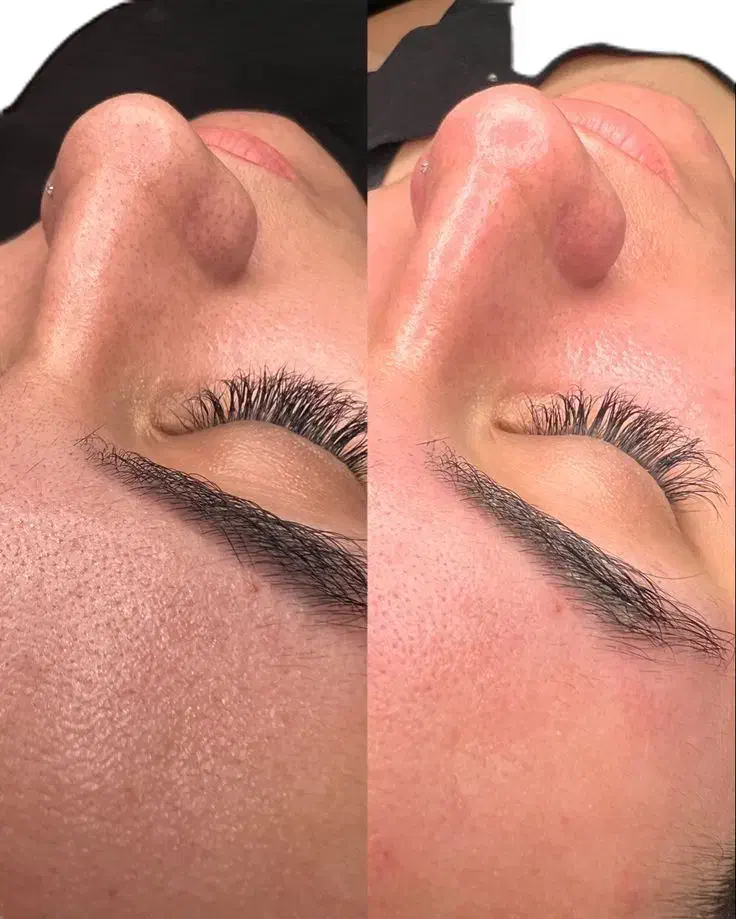 جشنواره پاییزه جوانسازی پوست فیشال پی ارپی اگزوزم|خدمات آرایشگری و زیبایی|مشهد, کوشش|دیوار