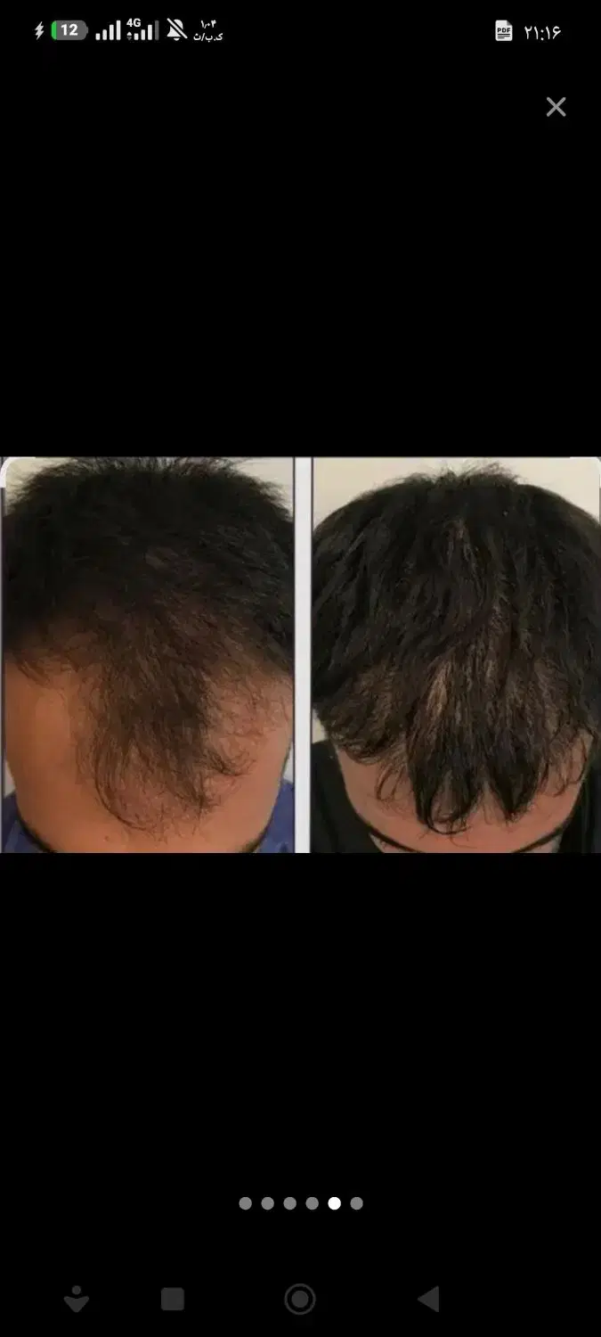 موهای شماضعیف شده یادچارریزش موشده اید|خدمات زیبایی و سلامت|تبریز, |دیوار