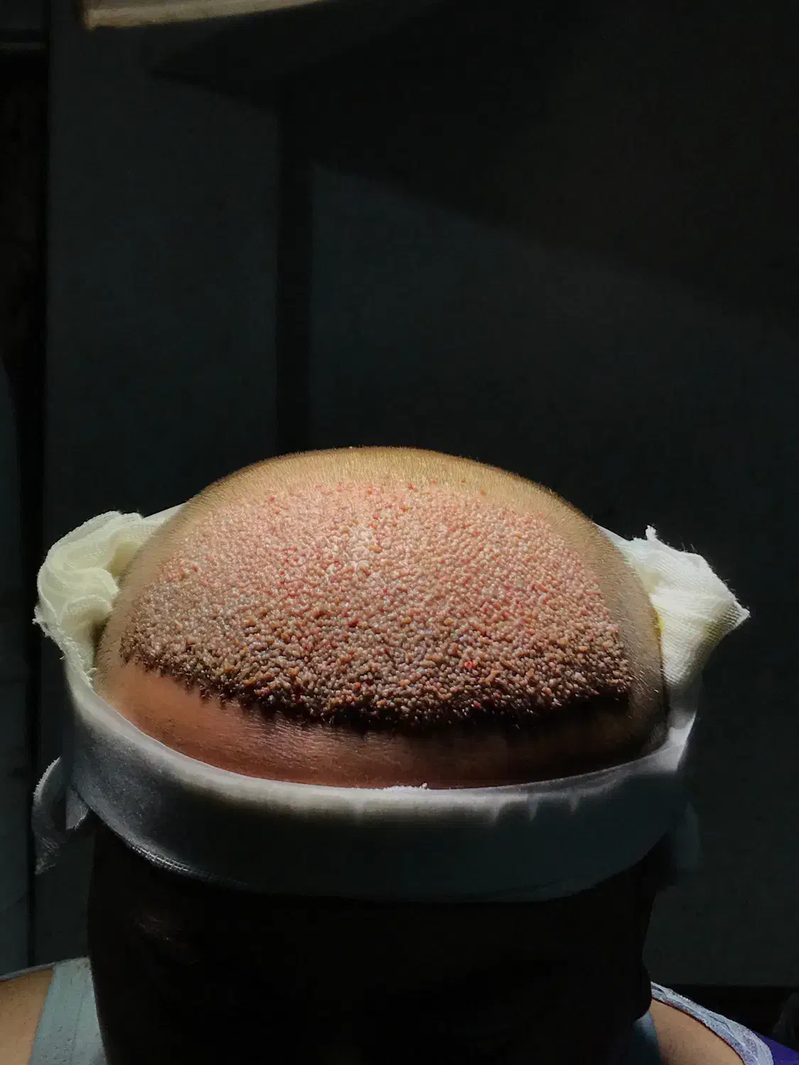 کاشت مو تخصصی در اردبیل|خدمات آرایشگری و زیبایی|اردبیل, |دیوار