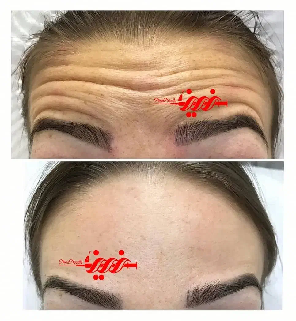 تزریق فیلر ژل و بوتاکس در کلینیک|خدمات آرایشگری و زیبایی|بندرعباس, |دیوار