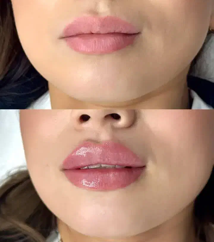 جشنواره تخفیفات ژل بوتاکس دکترکاظمی|خدمات آرایشگری و زیبایی|مشهد, کوثر|دیوار