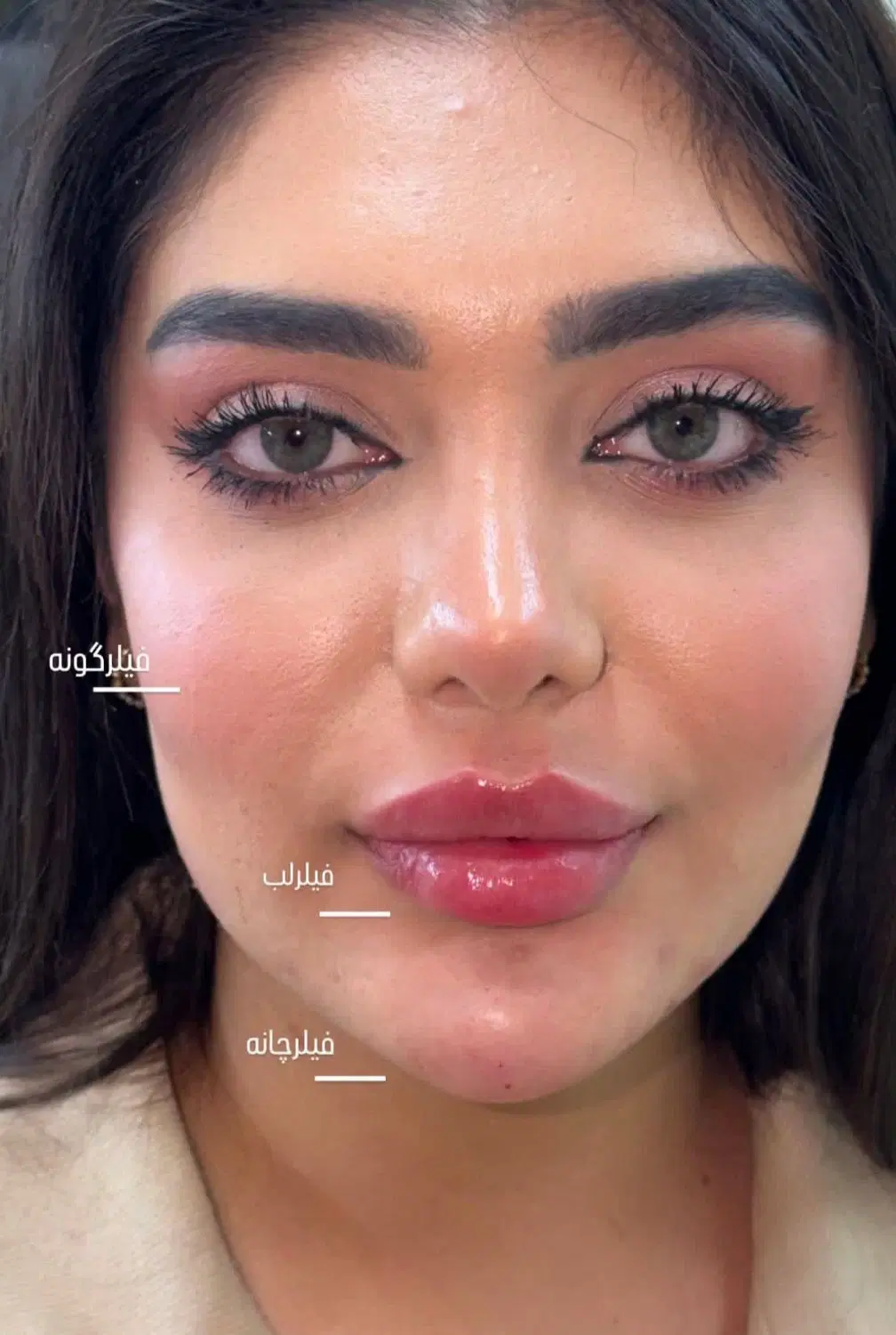 ژل لب روسی جشنواره بوتاکس لیزر بدن مید فیس کرج|خدمات زیبایی و سلامت|کرج, گوهردشت|دیوار