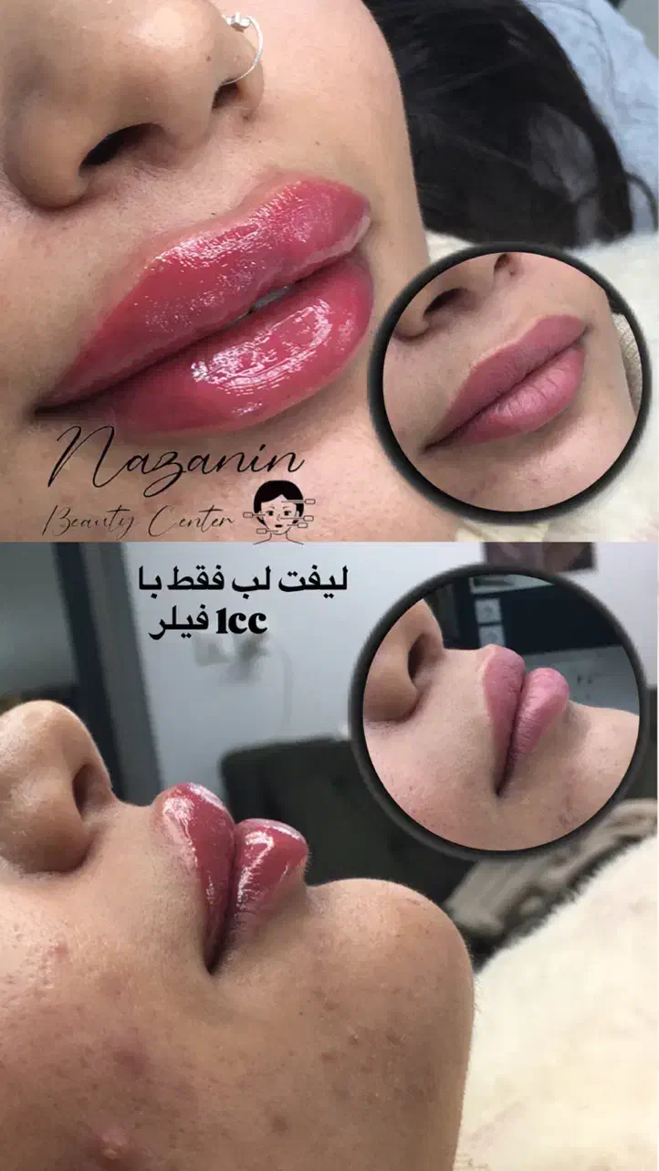 بوتاکس، فیلر و خدمات پیرسینگ|خدمات آرایشگری و زیبایی|رشت, خواهر امام|دیوار