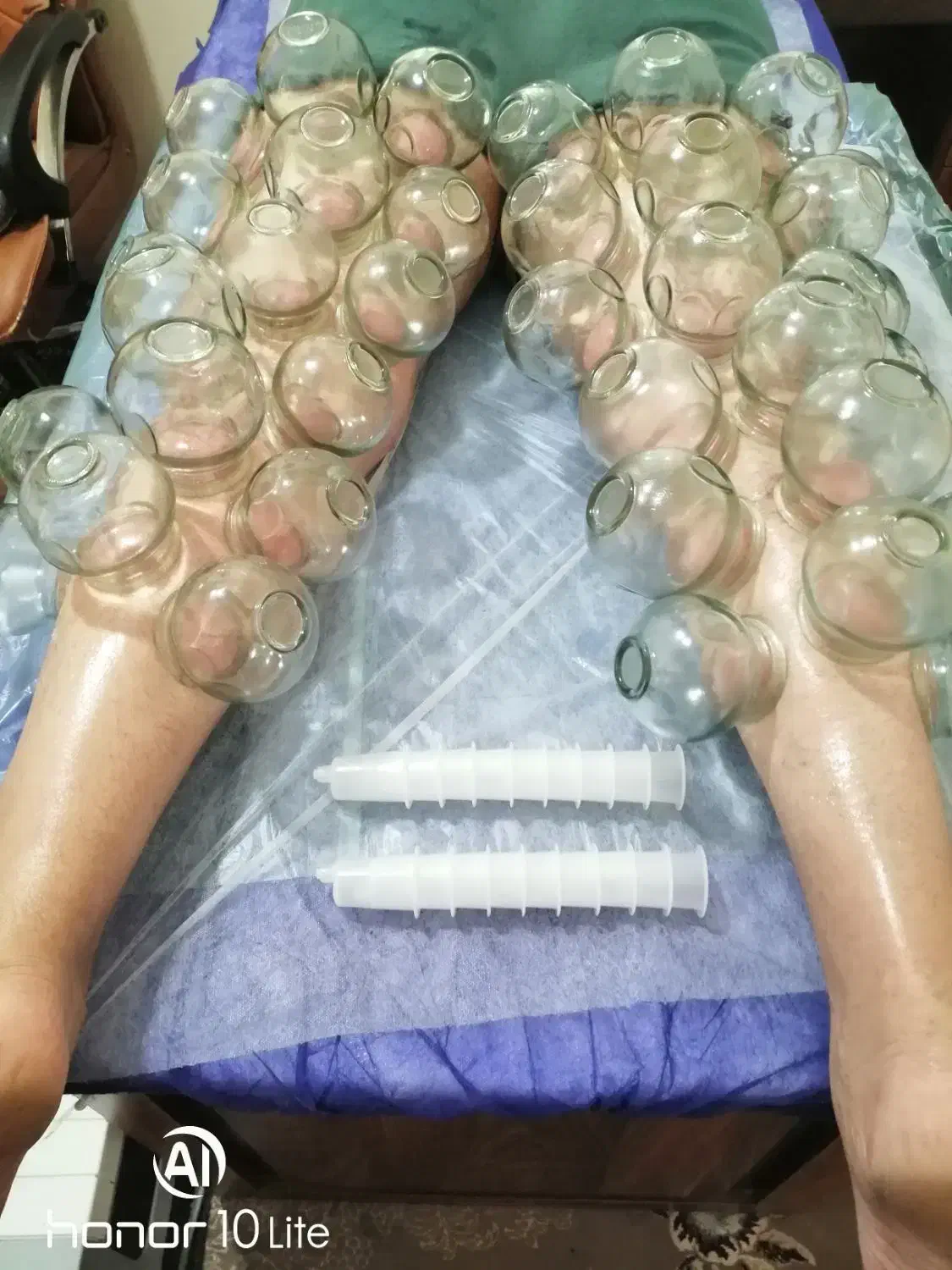 سم زدایی و پاکسازی بدن با حجامت تخصصی و ویژه|خدمات آرایشگری و زیبایی|بندر کنگان, |دیوار