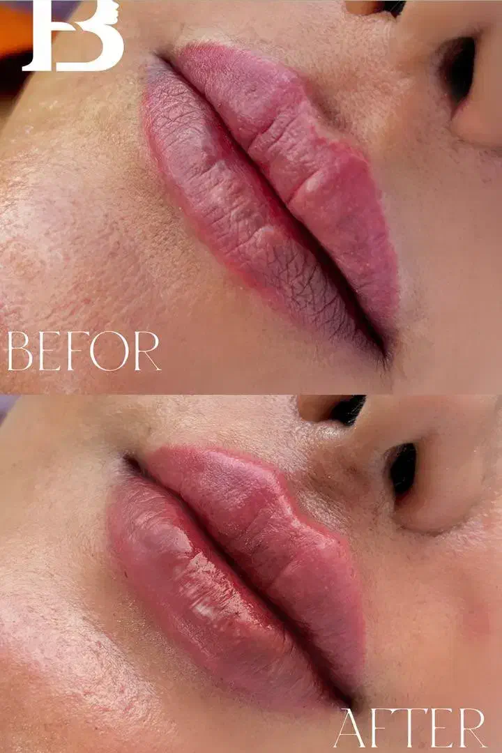 بوتاکس،فیلر،مزو،مزوژل،پی‌آرپی|خدمات آرایشگری و زیبایی|شیراز, خلدبرین|دیوار