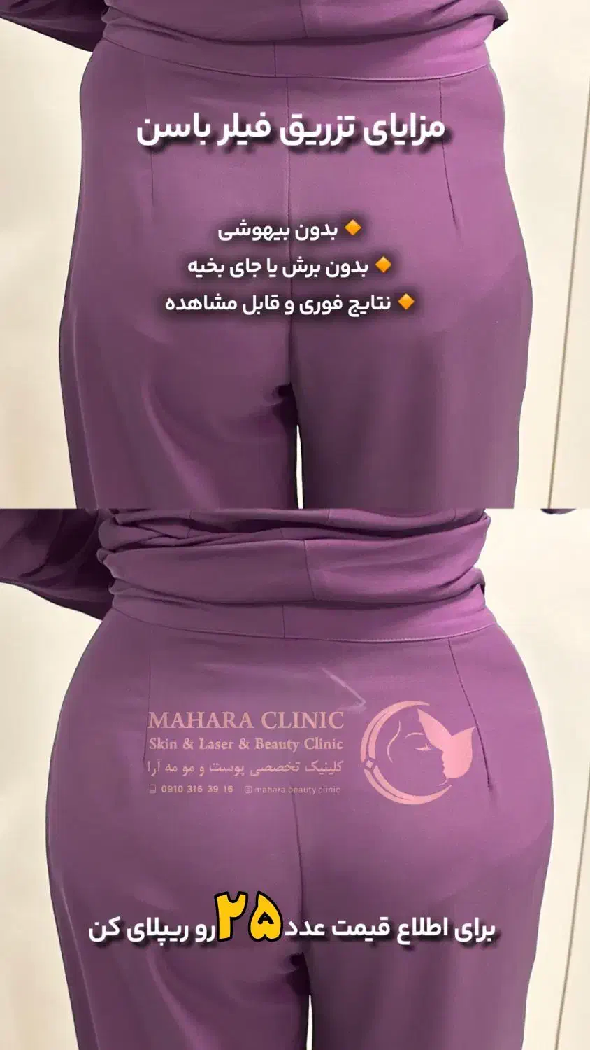 آف ۵۰٪ فیلر بادی هیپ دیپ سینه بیکینی باسن دست پا|خدمات آرایشگری و زیبایی|مشهد, نیروی هوایی|دیوار