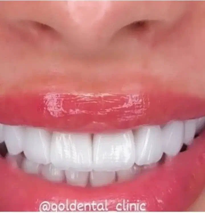 کامپوزیت دندان روکش دندانپزشک تهرانسر اکباتان خلیج|خدمات آرایشگری و زیبایی|تهران, تهرانسر شمالی|دیوار