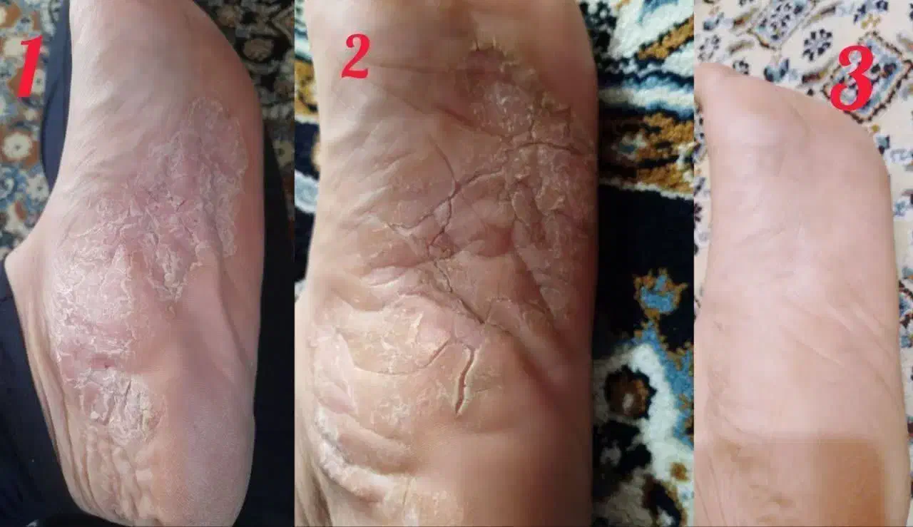 درمان پسوریازیس واگزما|فعالیت داوطلبانه|کرمان, |دیوار