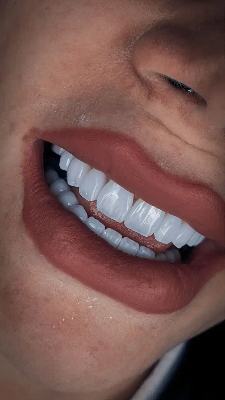 جشنواره بمناسبت روز مادر ایمپلنت، عصب کشی، جراحی،|خدمات آرایشگری و زیبایی|مشهد, شریف|دیوار