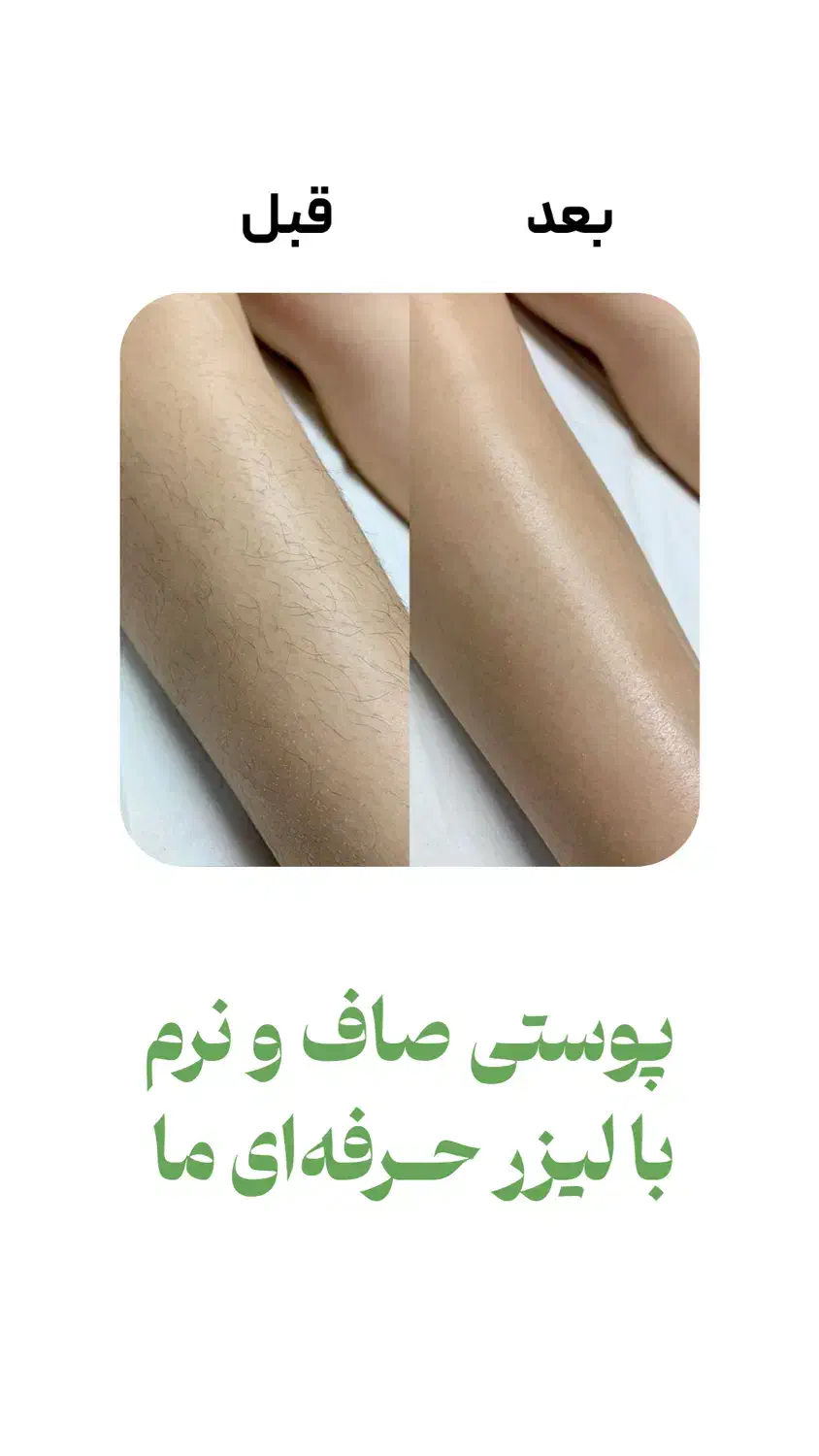 لیزر موزاید خانمها وآقایان شاتی ورولی450 هزارتومان|خدمات آرایشگری و زیبایی|تهران, فردوس|دیوار