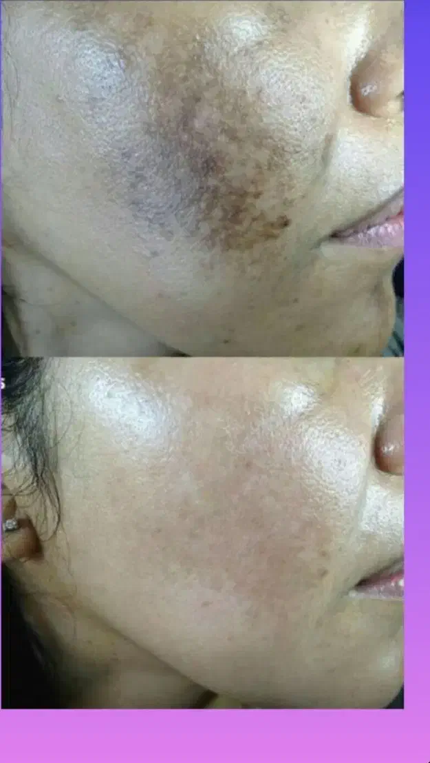 درمان لک درخانه|آرایشی، بهداشتی، درمانی|زرند, |دیوار