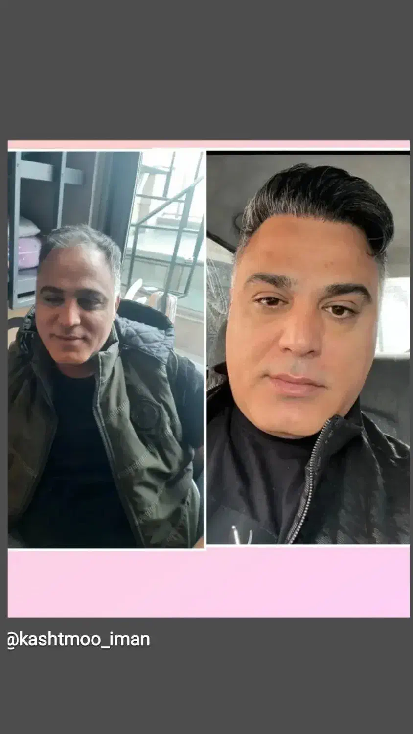 کاشت مو تخصصی|خدمات آرایشگری و زیبایی|تبریز, |دیوار