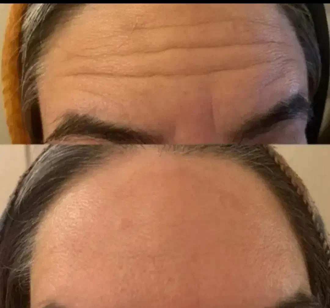 تزریق ژل وبوتاکس و آموزش فیلر با 5سال سابقه کاری|خدمات آرایشگری و زیبایی|جیرفت, |دیوار