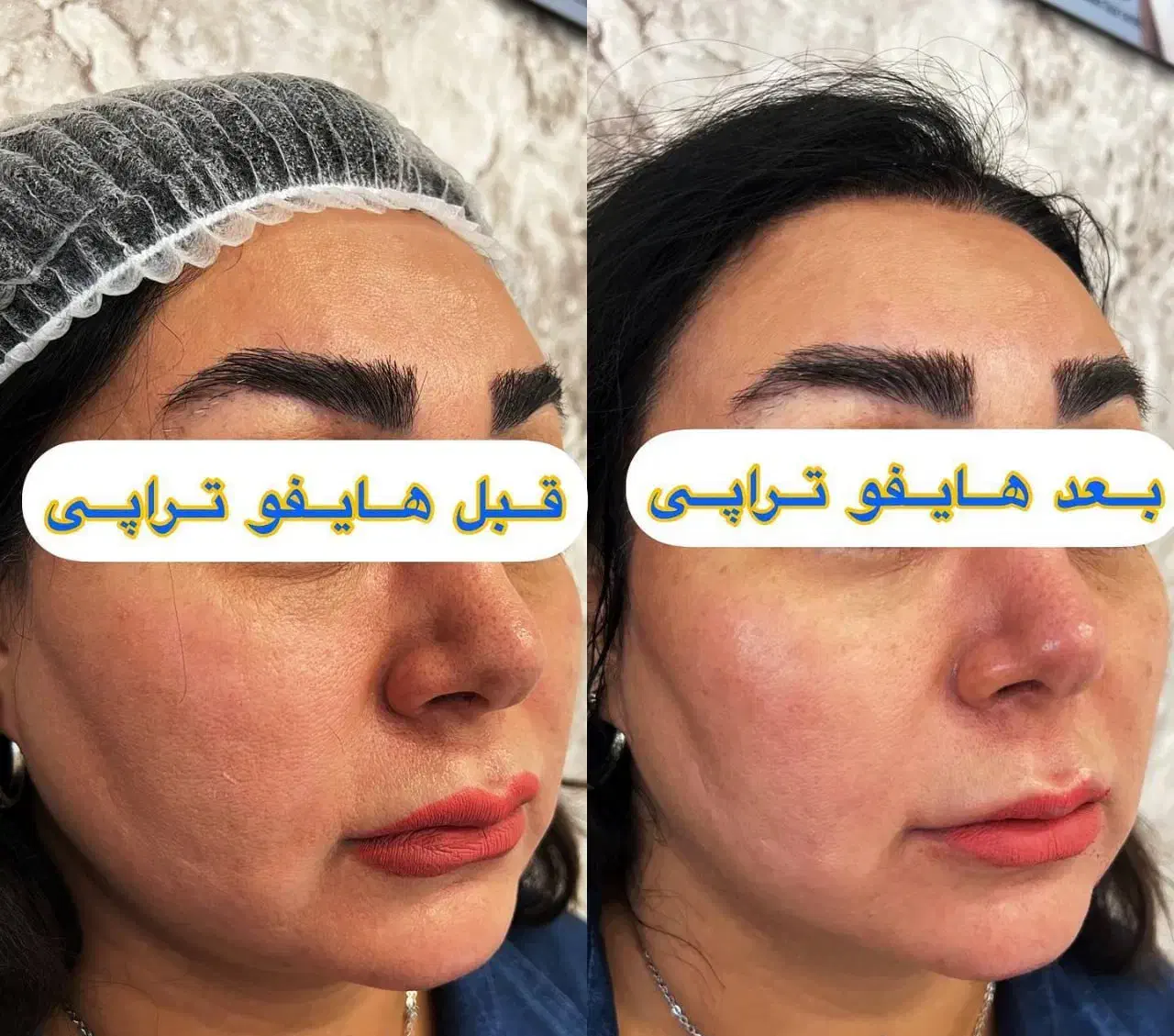 جشنواره هایفو ولیزر به مناسبت افتتاحیه ویلدا|خدمات آرایشگری و زیبایی|مشهد, آزادشهر|دیوار