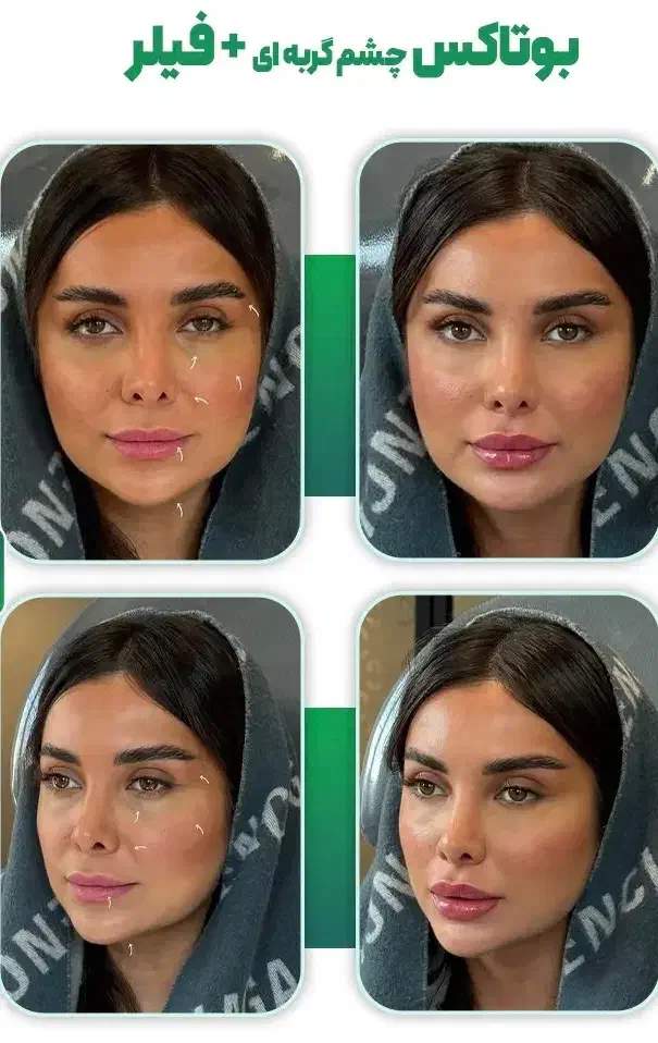 تخفیف ویژه تزریق1ccفیلر برند و معتبر+بوتاکس رایگان|خدمات آرایشگری و زیبایی|تهران, زعفرانیه|دیوار