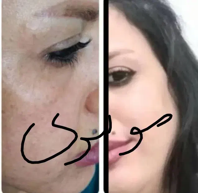 روشن کننده وضدلک درمانی بدون بازگشت تضمینی|آرایشی، بهداشتی، درمانی|یاسوج, |دیوار