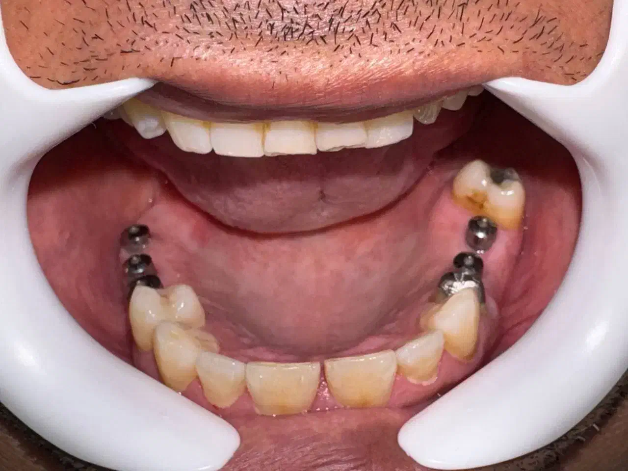 ایمپلنت دیجیتال اقساطی بدون سود در انواع برندها|خدمات آرایشگری و زیبایی|شیراز, زرگری|دیوار