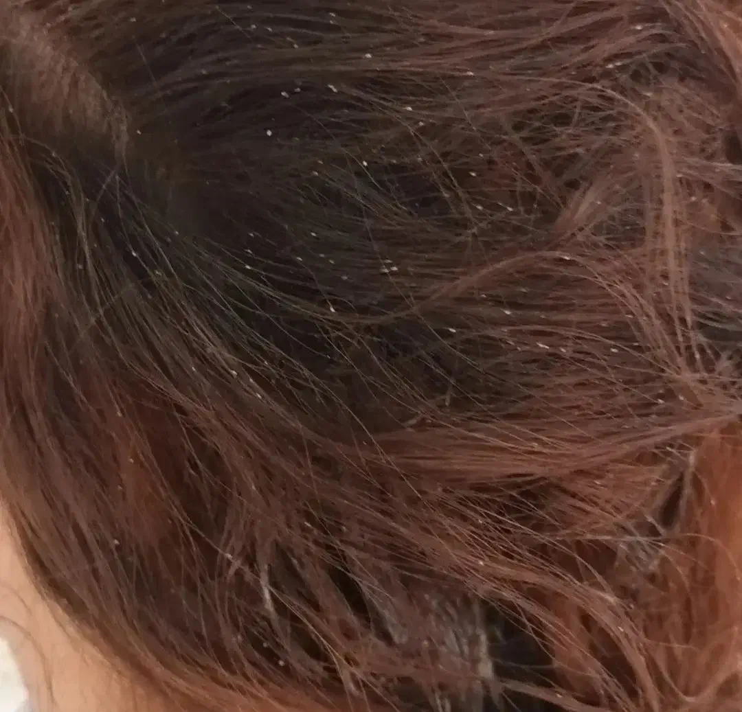 پاکسازی رشک و شپش|آرایشی، بهداشتی، درمانی|رباط‌کریم, شهرک درخشان|دیوار