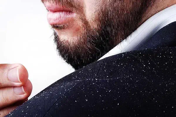 درمان بدون درد سر شوره مو|آرایشی، بهداشتی، درمانی|شادگان, |دیوار