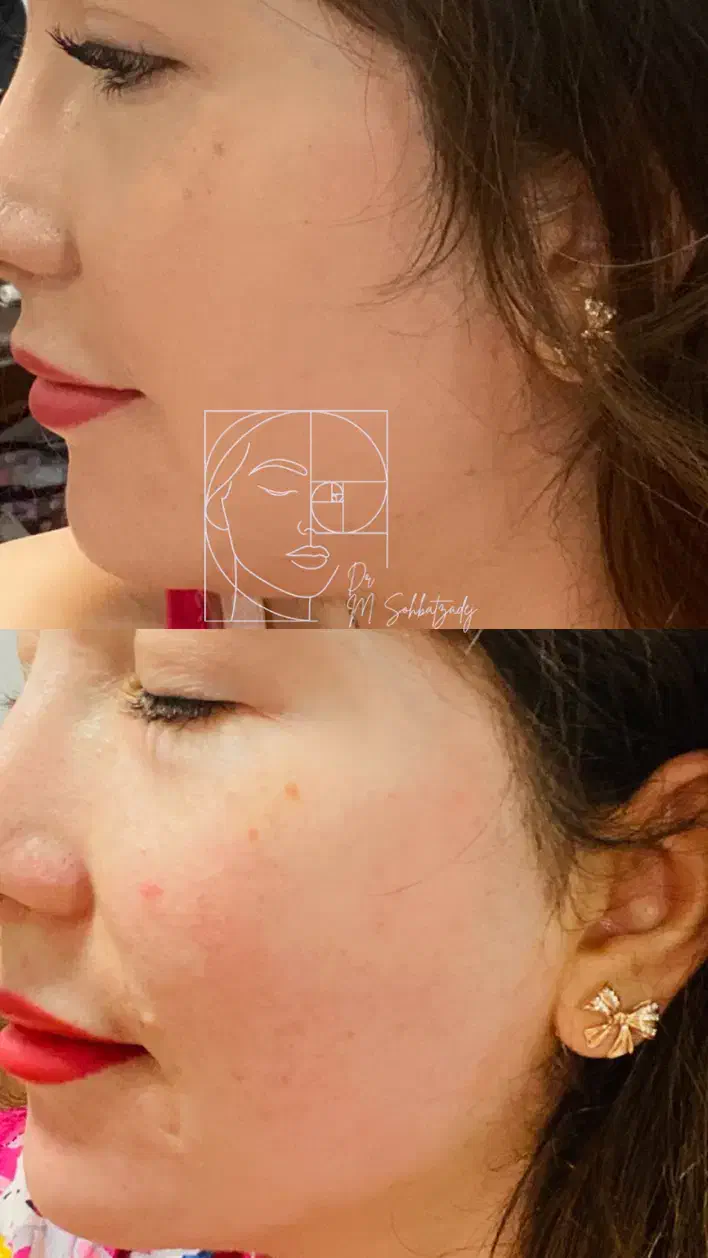 بوتاکس و فیلر صورت برای مدل تحت نظر پزشک|خدمات آرایشگری و زیبایی|زنجان, |دیوار