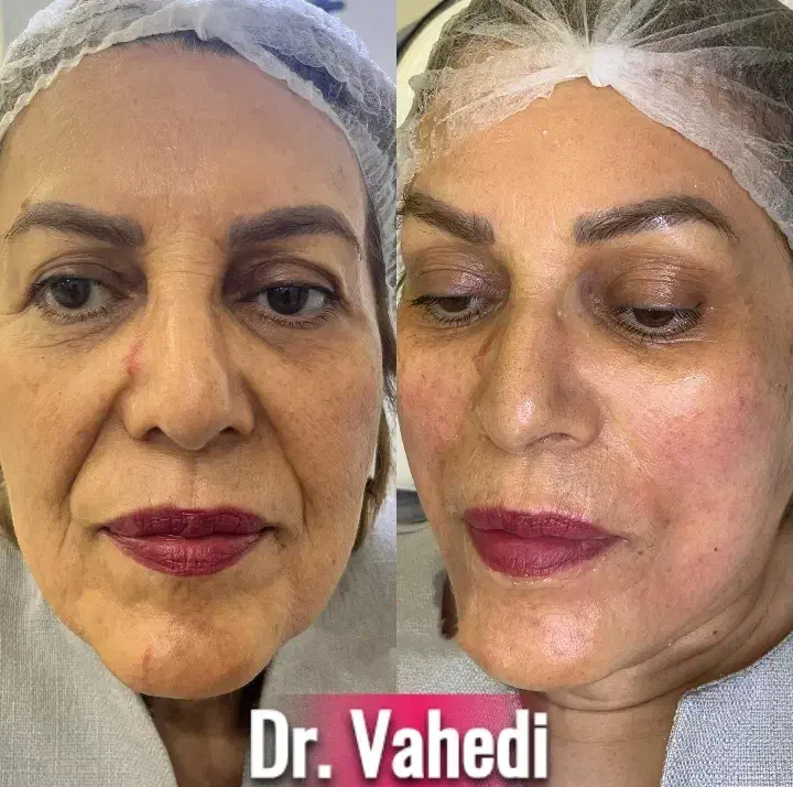 تخفیف ویژه لیفت و جوانسازی صورت|خدمات آرایشگری و زیبایی|مشهد, چهارچشمه|دیوار